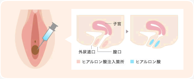 膣ヒアルロン酸注入